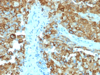 FFPE human melanoma sections stained with 100 ul anti-gp100 (clone PMEL/2038) at 1:50. HIER epitope retrieval prior to staining was performed in 10mM Citrate, pH 6.0.
